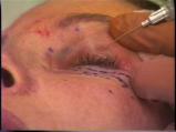 Cosmetic surgery needle to eyelid